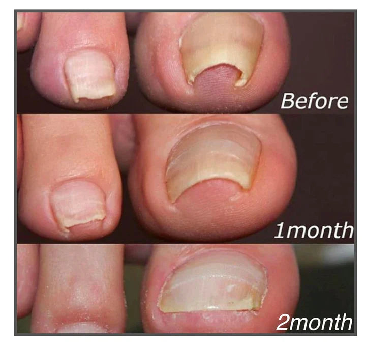 Corrigerende patches voor gezonde en mooie nagels 